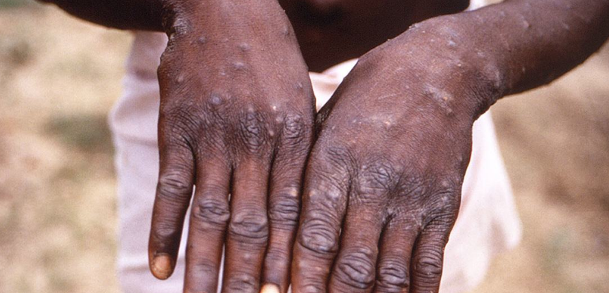 Monkeypox outbreak  reported in 16 countries
